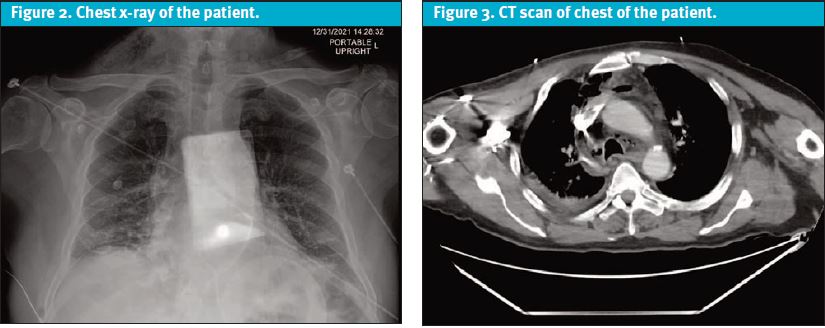 Sever Illness in Urgent Care - chest x-ray and CT Scan of patient