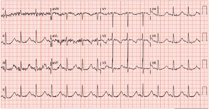 hypokalemia