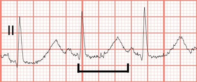 hypokalemia