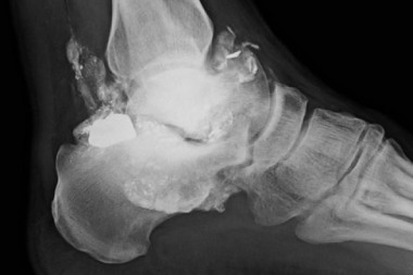 A 35-Year-Old with Ankle Pain and a History of Gunshot Wound