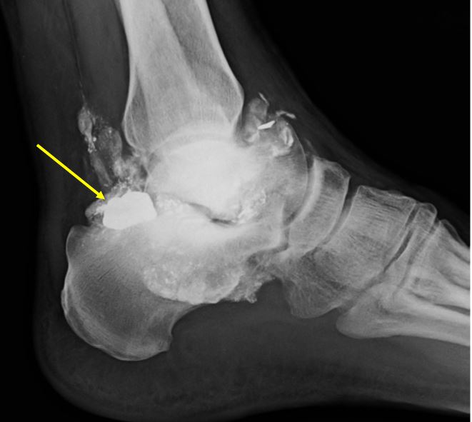 lead arthropathy - x-ray image