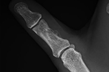 A 38-Year-Old Female with Persistent Pain Months After Being Bitten