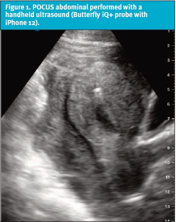 Point of Care Ultrasound Diagnosis of Ruptured Ectopic Pregnancy