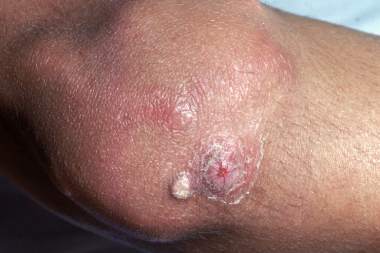 A 7-Year-Old Male with Lesions on His Knees