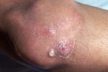 A 7-Year-Old Male with Lesions on His Knees