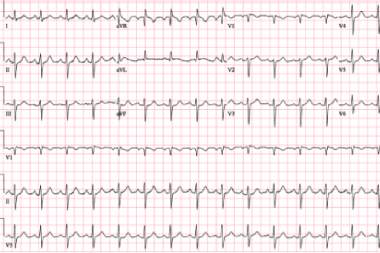 A 61-Year-Old Female with History of Hypertension and New Palpitations and Shortness of Breath