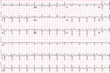A 61-Year-Old Female with History of Hypertension and New Palpitations and Shortness of Breath