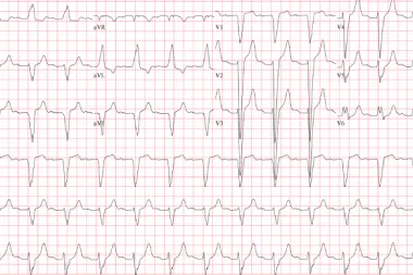 A 69-Year-Old Male with Left-Sided Chest Pain and Dyspnea for 3 Days