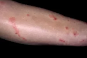 Sporotrichosis