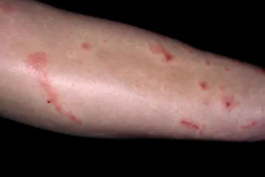 A 46-Year-Old with Evolving Sores on Her Hand and Arm