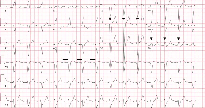 Figure 2: The wide QRS (>120 msec), dominant S wave in V1 (asterisks), broad notched R wave in V6 (arrowheads) and absent q waves in lead I, V5, and V6 indicates the presence of a left bundle branch block.  The PR interval is prolonged (horizontal line).