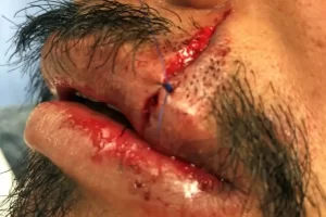 lip laceration in urgent care