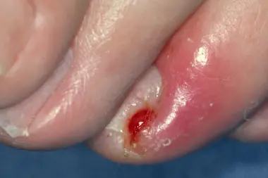 A 59-Year-Old with a Painful Finger Skin Lesion