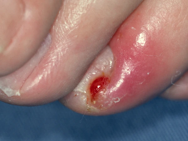 Painful Finger Skin Lesion