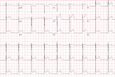 A 30-Year-Old Male with Chest and Leg Pain—and a History of Polysubstance Use