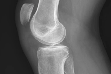 A 41-Year-Old with Knee Pain After Playing Basketball