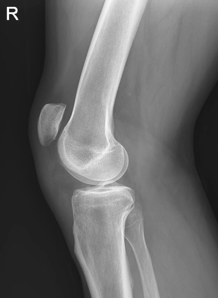 Patellar tendon rupture