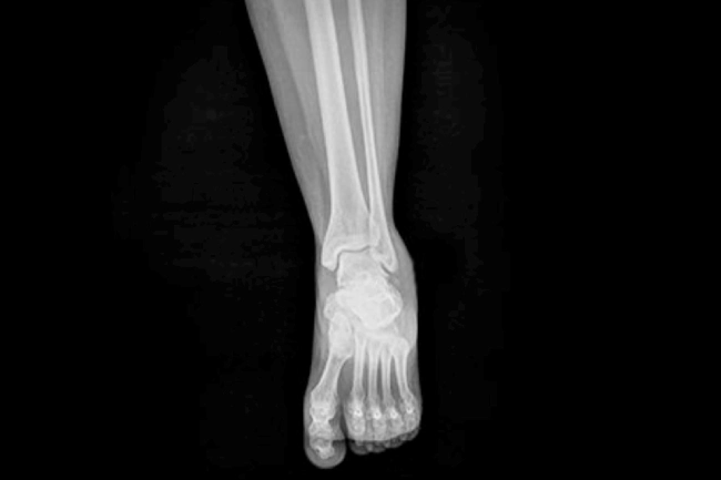 Pediatric Avulsion Fracture of the Ankle