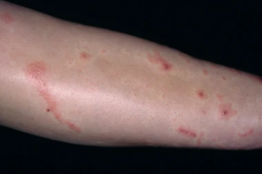 A 23-Year-Old with a Pruritic, Spreading Rash
