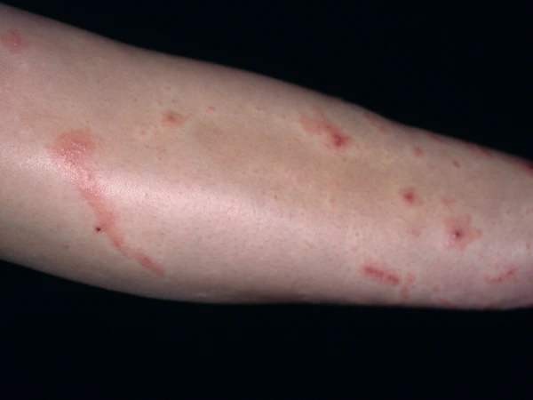 Pruritic Spreading Rash