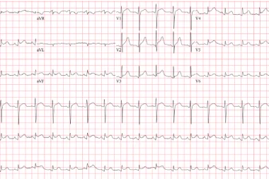 A 67-Year-Old Male with Chest Pain, Dyspnea, and a History of Lung Cancer