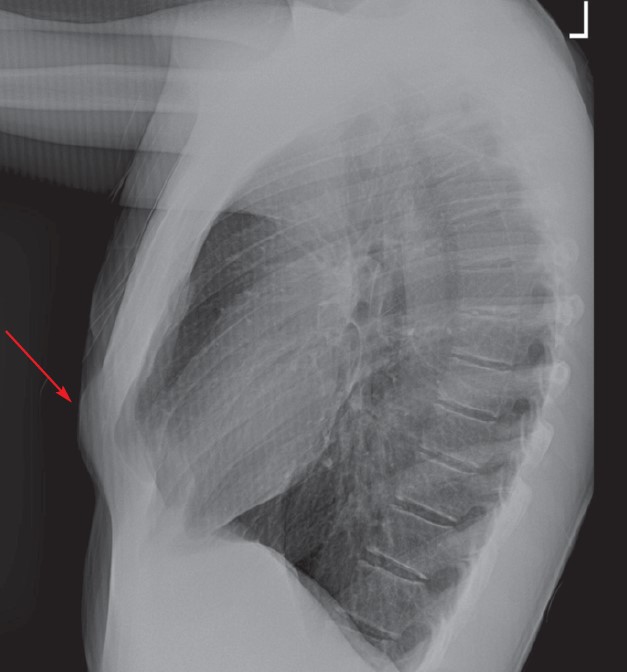45-Year-Old with Chest Deformity issue identified