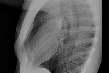 A 45-Year-Old with Chest Deformity