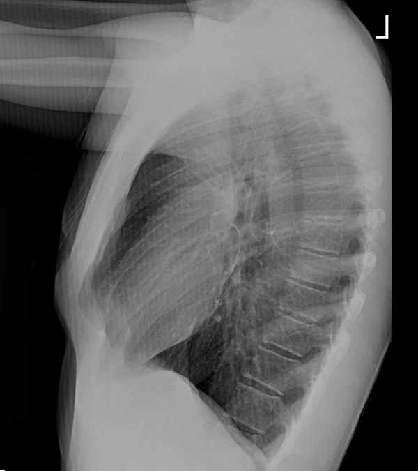 45-Year-Old with Chest Deformity