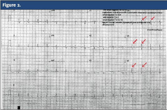 EKG with Poor R wave