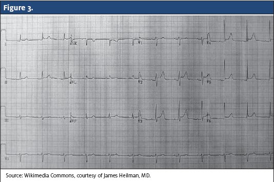 Another EKG with Poor R wave and poor alternans