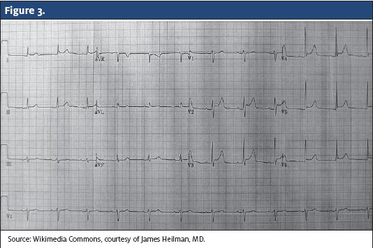 Another EKG with Poor R wave and poor alternans