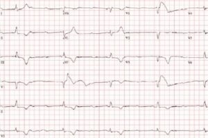 Dizziness and a Slow Heartbeat