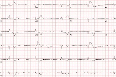 A 75-Year-Old Female with Dizziness and a Slow Heartbeat