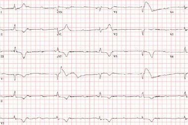 A 75-Year-Old Female with Dizziness and a Slow Heartbeat