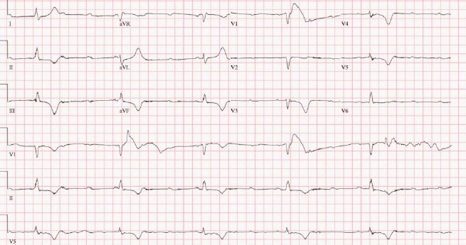Dizziness and a Slow Heartbeat Patient ECG Figure 1.