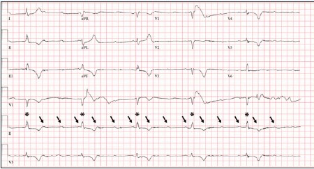 Dizziness and a Slow Heartbeat Patient ECG 2