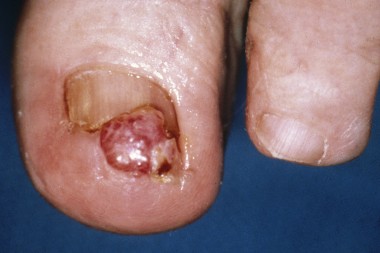 A 49-Year-Old with a 4-Week-Old Lesion on Her Toe
