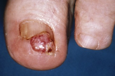A 49-Year-Old with a 4-Week-Old Lesion on Her Toe A 49-Year-Old with a 4-Week-Old Lesion on Her Toe