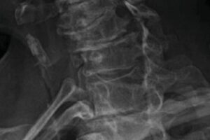 Perched facet joint, Neck Pain After a Car Crash