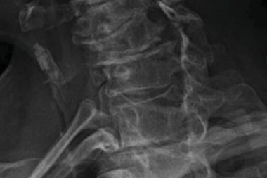 A 69-Year-Old with Neck Pain After a Car Crash