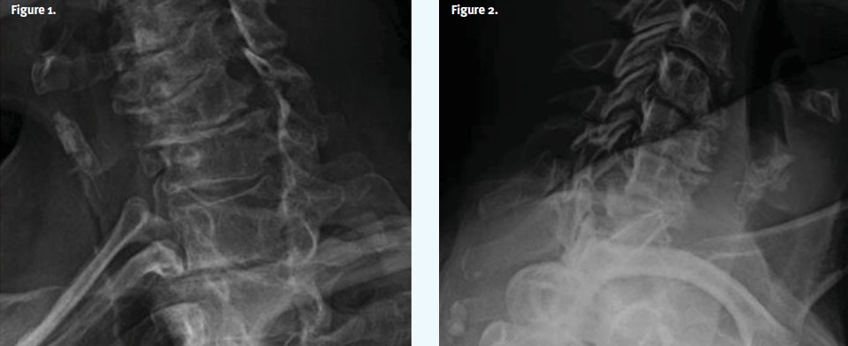 Neck Pain After a Car Crash: X-ray 1