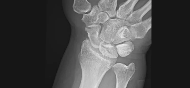 A 55-Year-Old Female with Sudden-Onset Wrist Pain