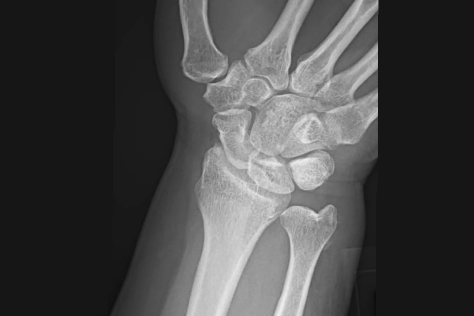 A 55-Year-Old Female with Sudden-Onset Wrist Pain