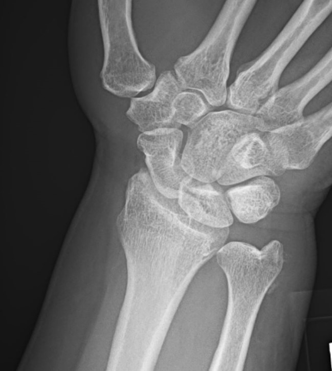 55-year-old with sudden on-set wrist pain x-ray