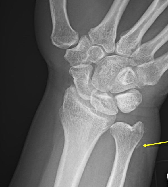 55-year-old female with sudden on-set wrist pain xr2