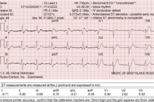 Male With Severe Worsening Chest Pain