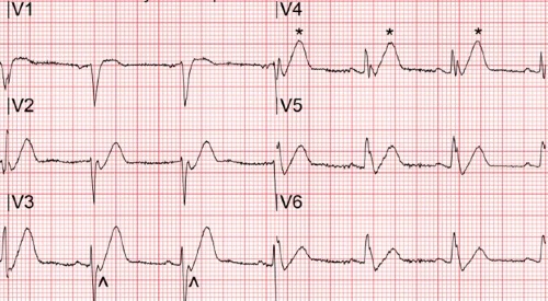 Male With Severe, Worsening Chest Pain