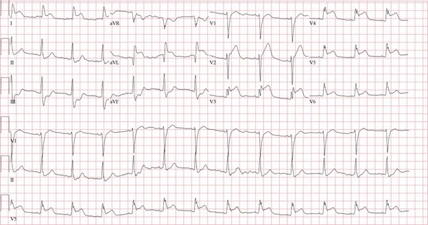 Male With Severe, Worsening Chest Pain