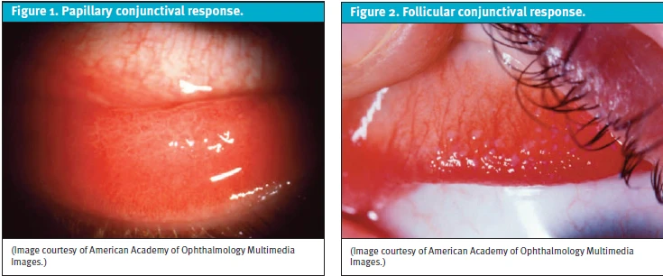 Differentiating Acute Conjunctivitis Presentations in Children