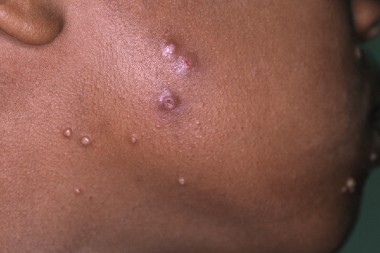 8-Year-Old With Facial Lesions